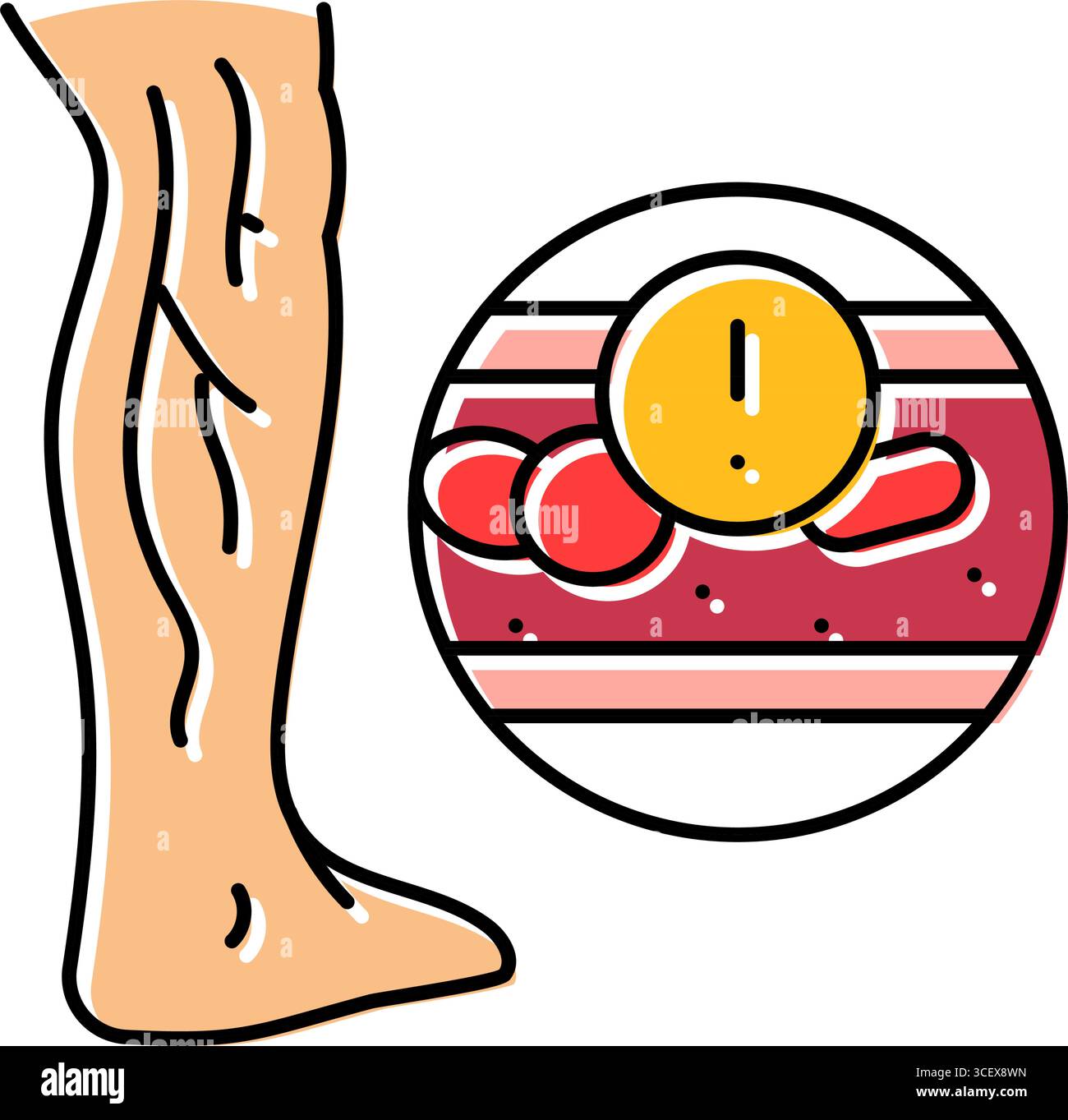 Deep vein thrombosis illustration hi-res stock photography and images ...