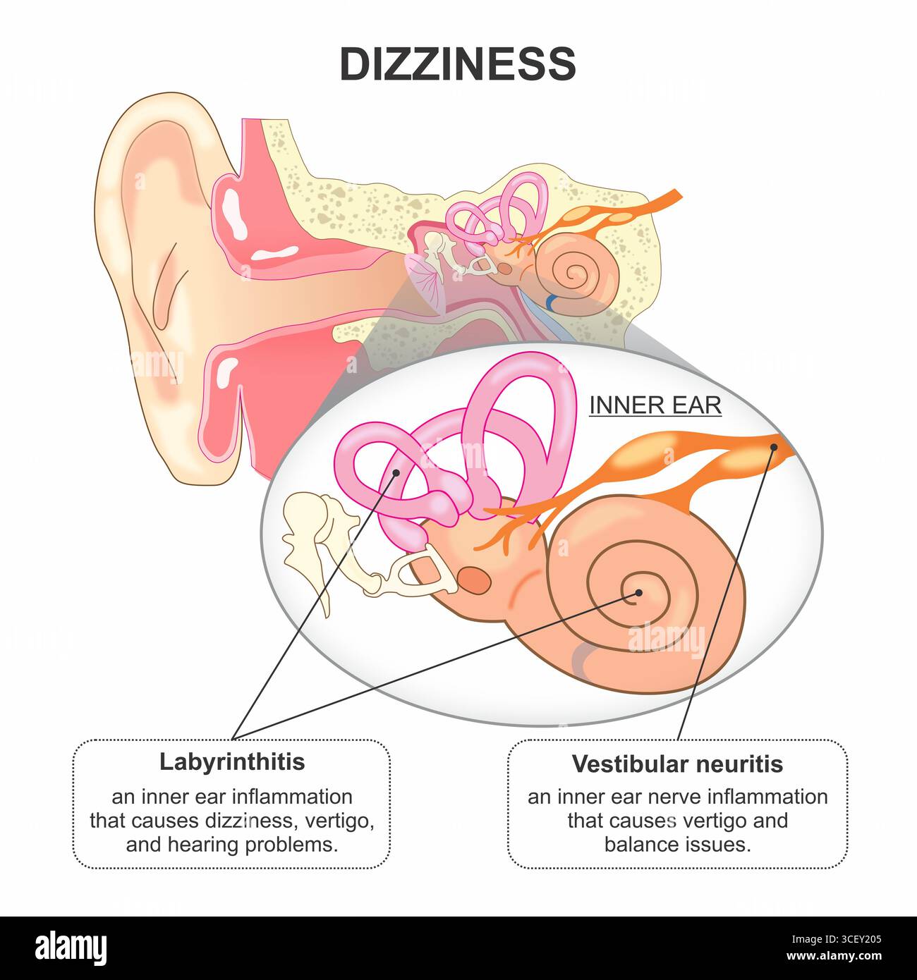 Ear dizziness hi-res stock photography and images - Alamy