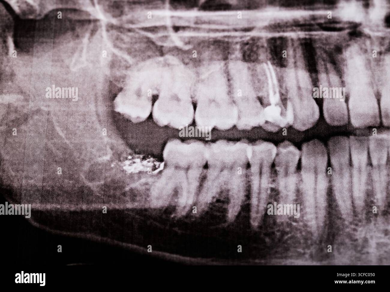 Empty Extraction Socket Radiograph Empty tooth socket with medicine after wisdom tooth removal on x-ray ...