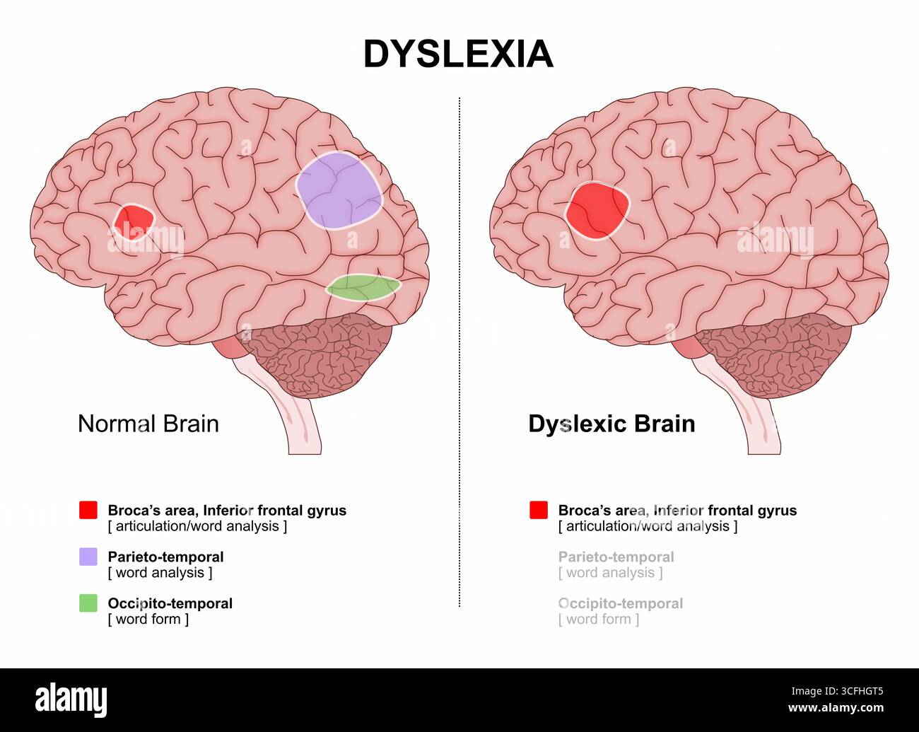 Dyslexia main image 1