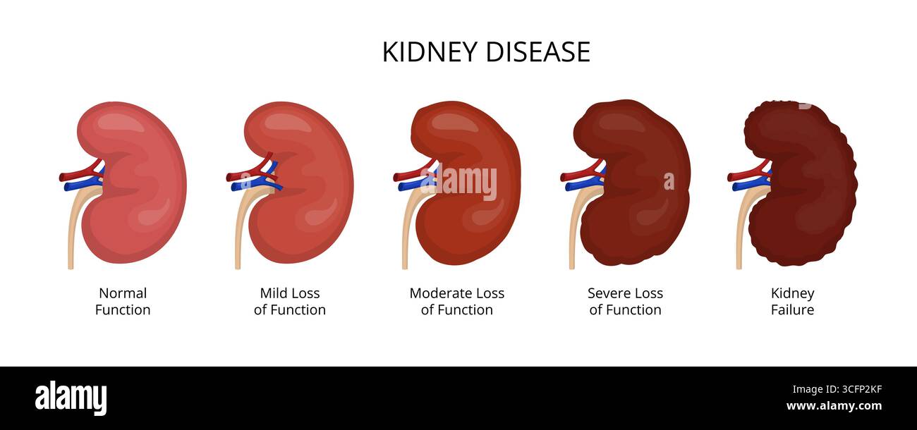 Moderate Ckd Chronic kidney disease stages hi-res stock photography and images - Alamy