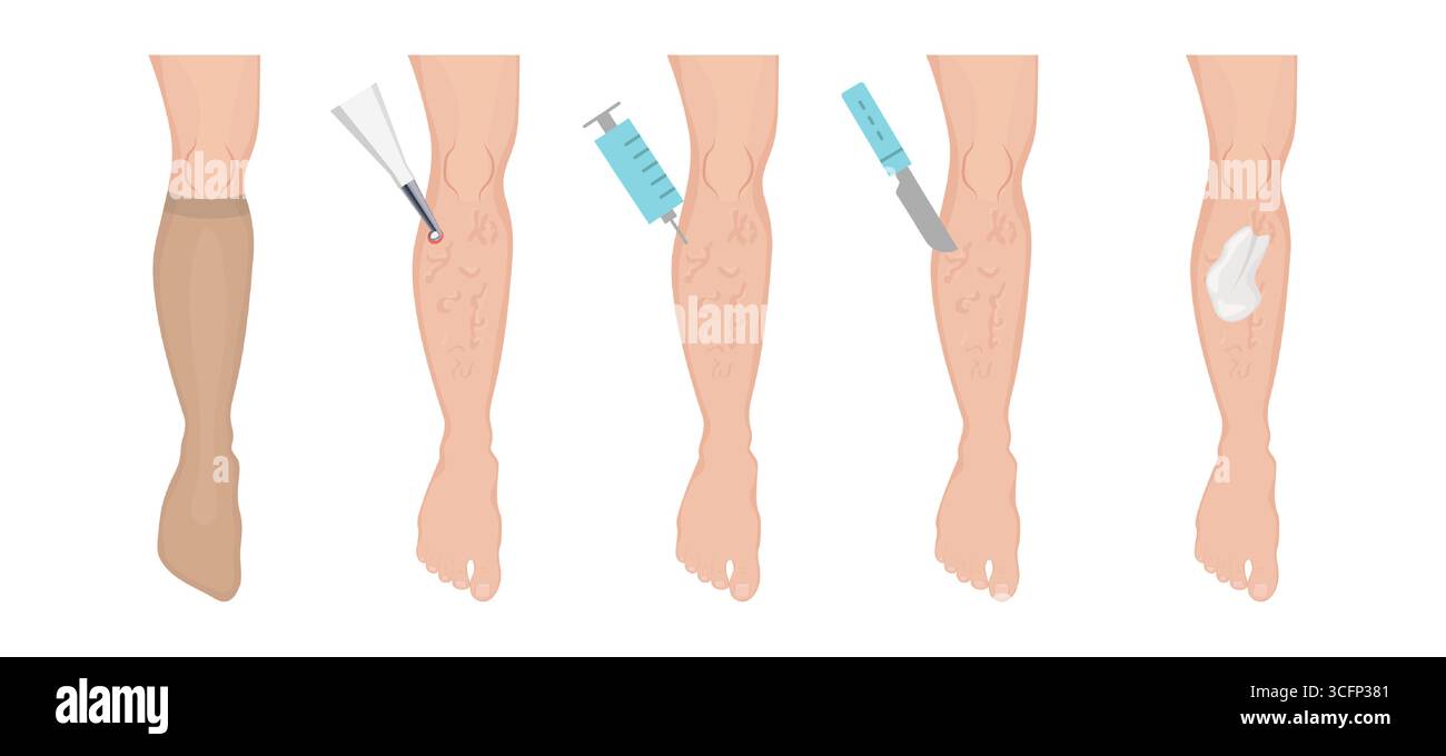 Varicose veins treatment methods using medical procedures including ...
