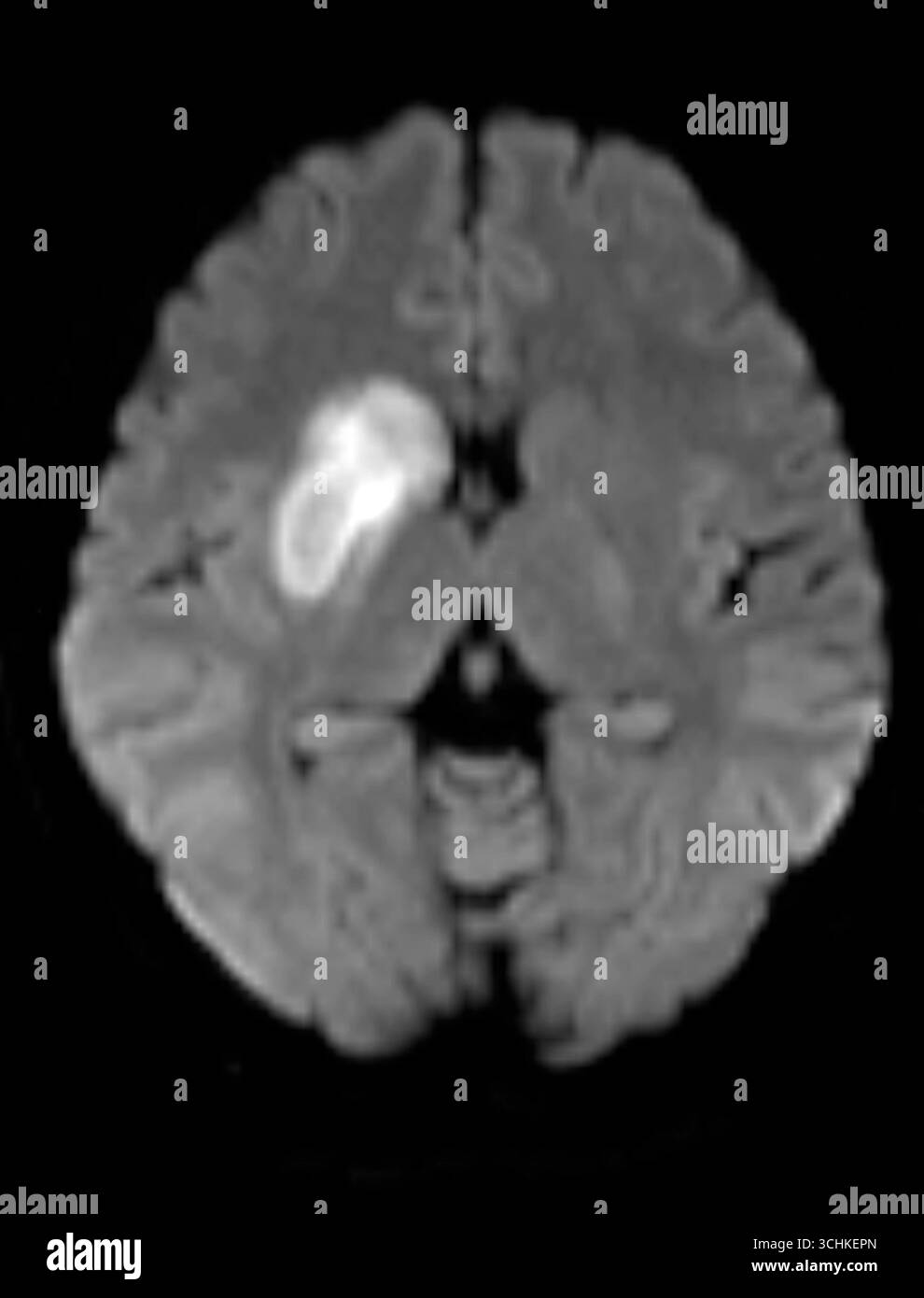 Mri Infarct Diffusion-weighted imaging (DWI) magnetic resonance imaging (MRI) scan ...