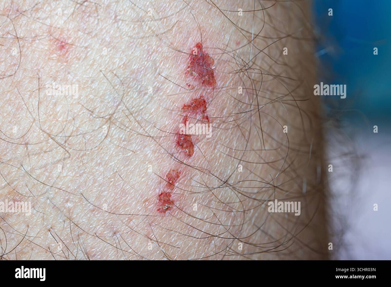Skin abrasion hi-res stock photography and images - Alamy