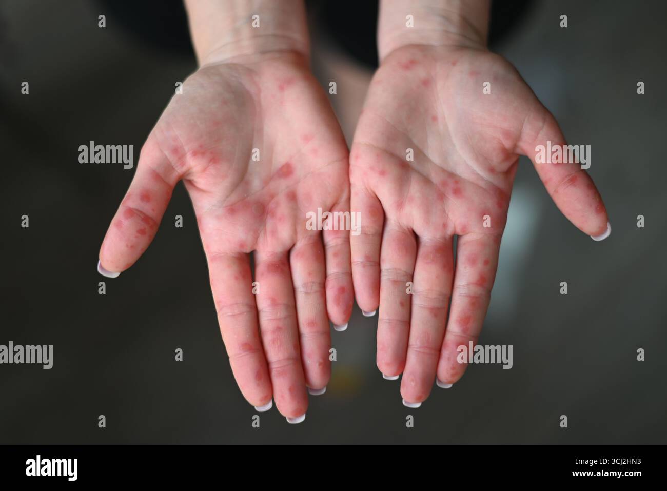 Close-up of human palms with red rash caused by Coxsackievirus, showing ...