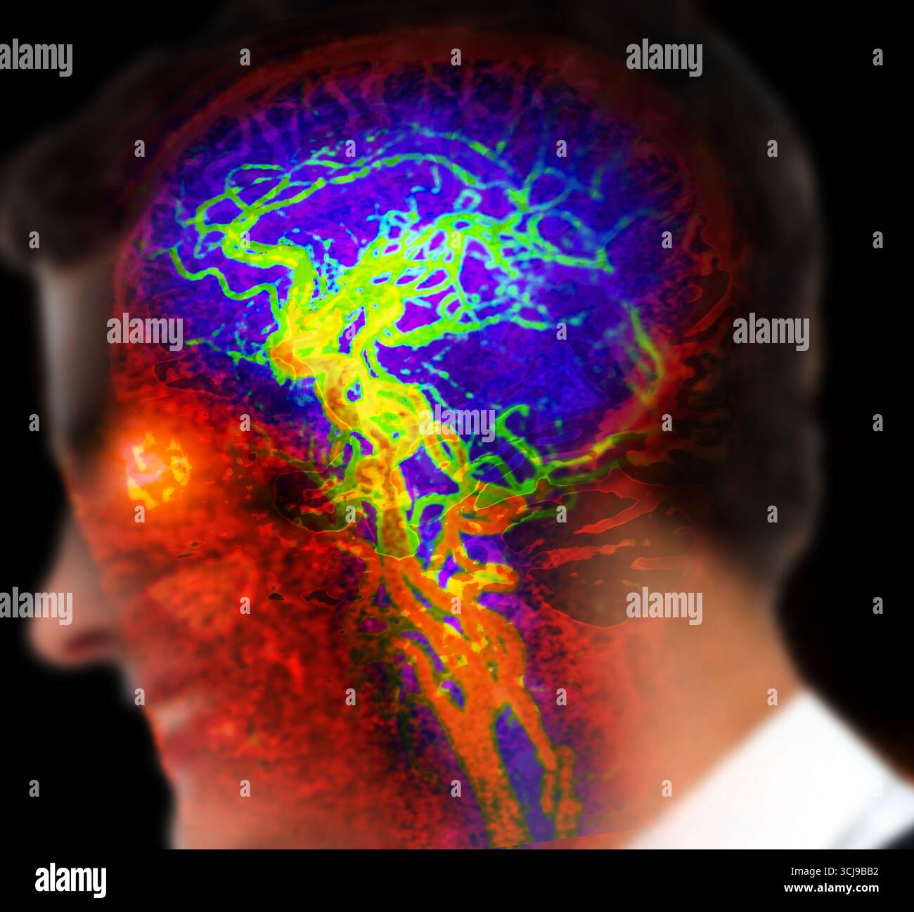 3d brain reconstruction blood vessels hi-res stock photography and ...