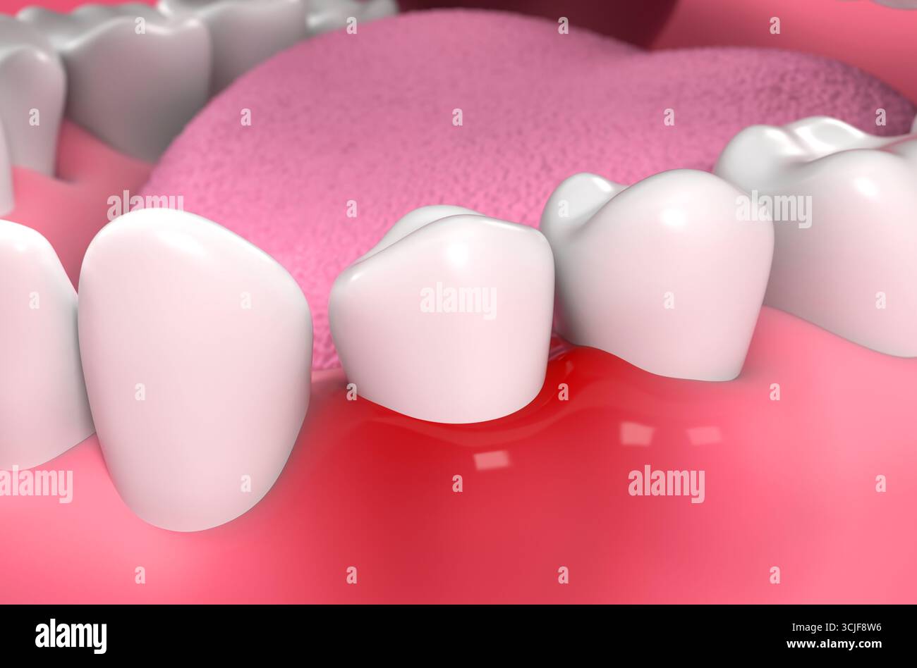 Inflammation of the gums (Gingivitis) - isometric view 3d illustration Stock Photo