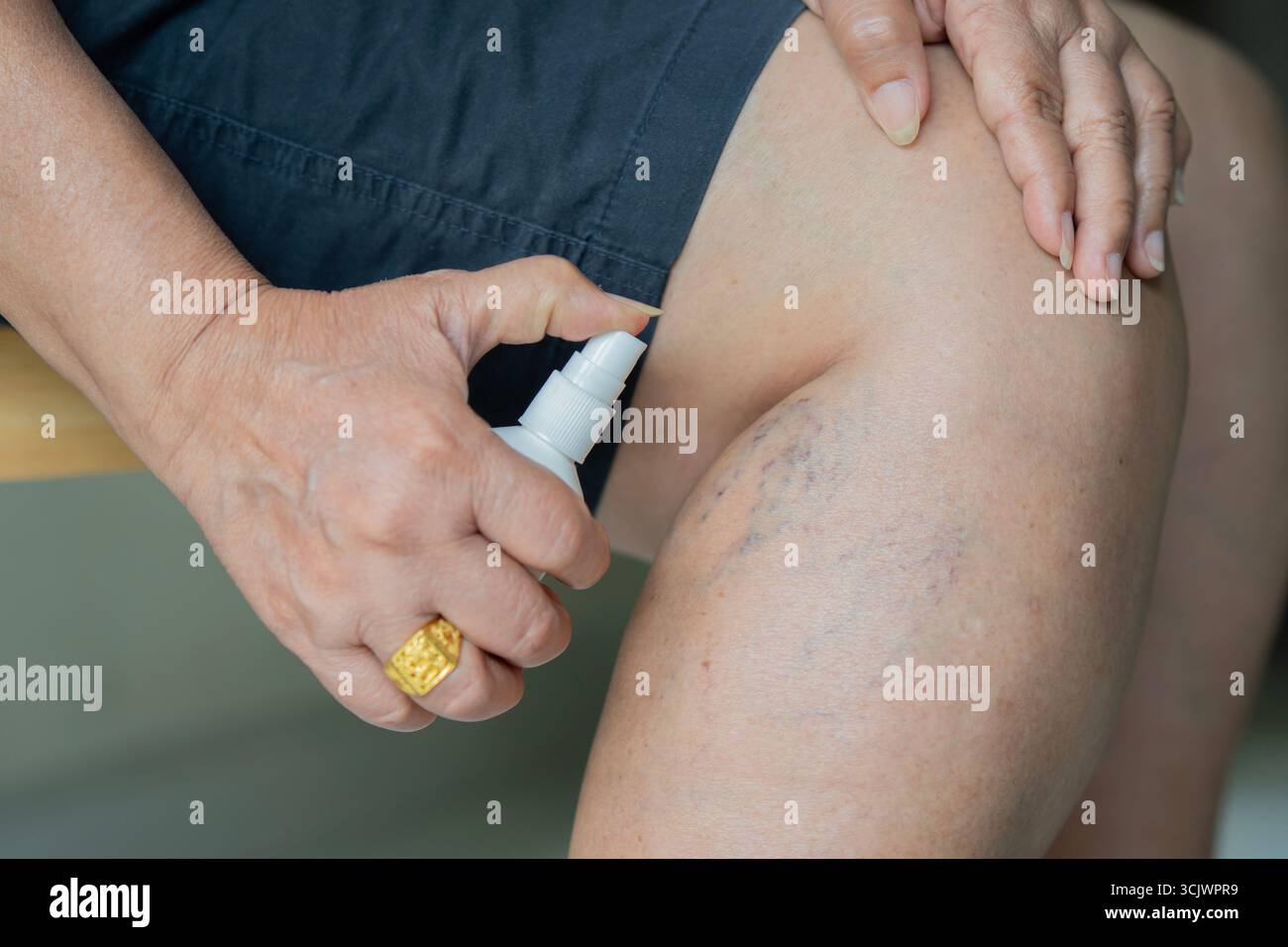 Close-up senior woman spraying medicine on thrombosis on legs Vascular disease, varicose vein problem. Treatment with medicine and cosmetology Stock Photo