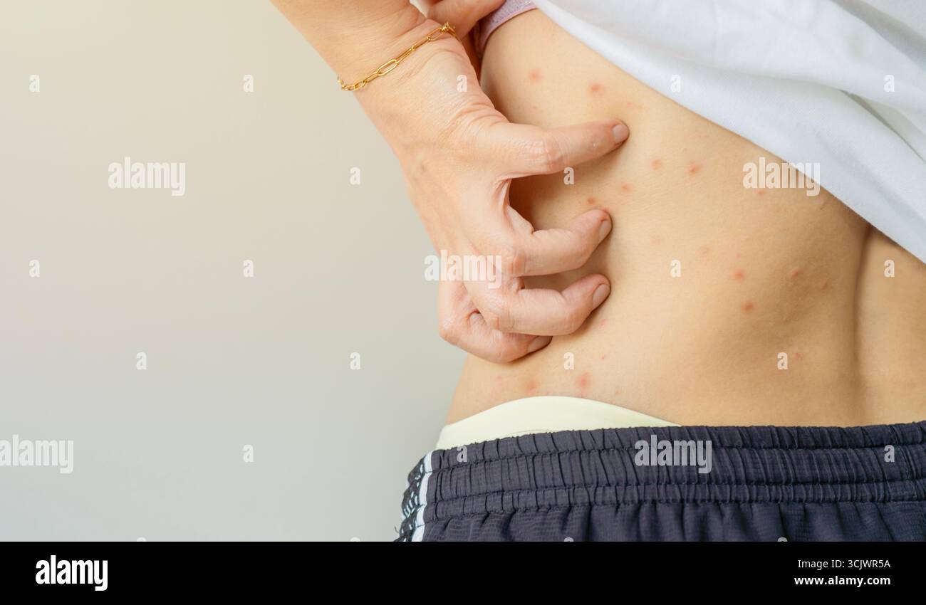 Doctor explains HEAT RASH (miliaria) in a baby | Causes, symptoms,  treatment and prevention, image size:1300x850