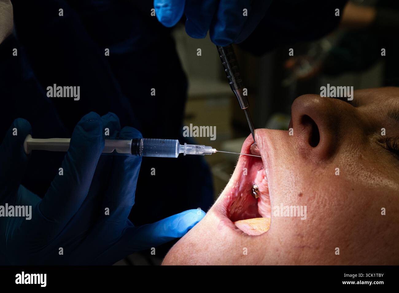 During implant treatment, a doctor performs an injection. The dentist ...
