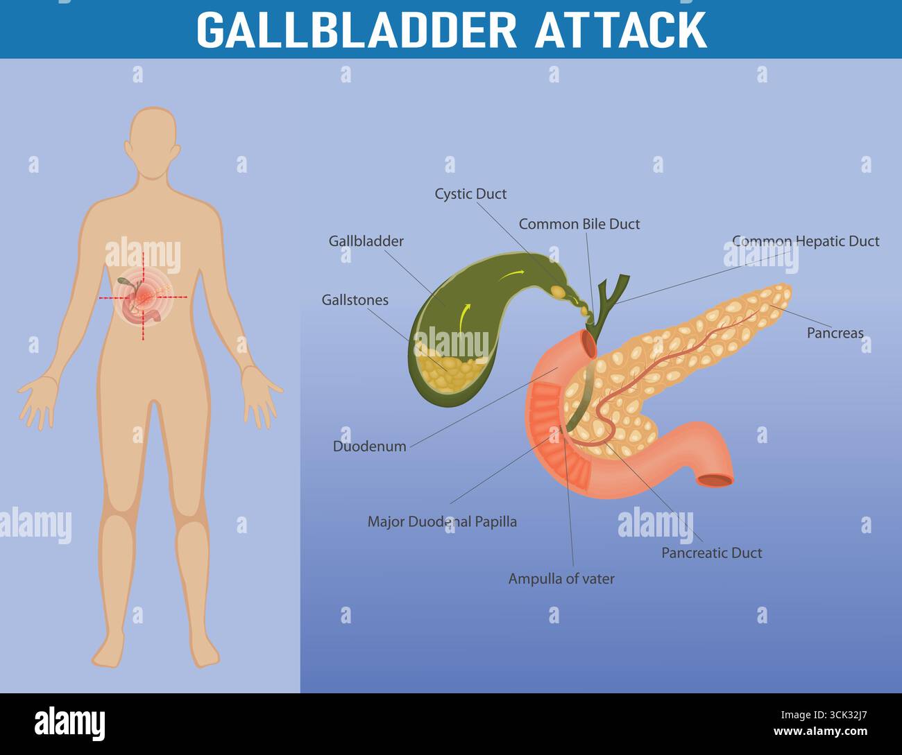 Gallbladder Path Gallstones hi-res stock photography and images - Alamy