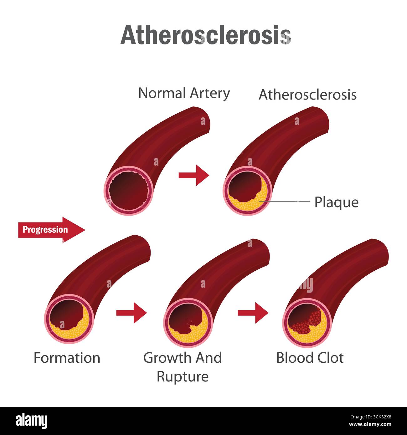 Atherosclerosis Stages Infographic Showing Artery Plaque Formation, Growth, Rupture, and Blood Clot Development in Human Circulatory System. Stock Vector