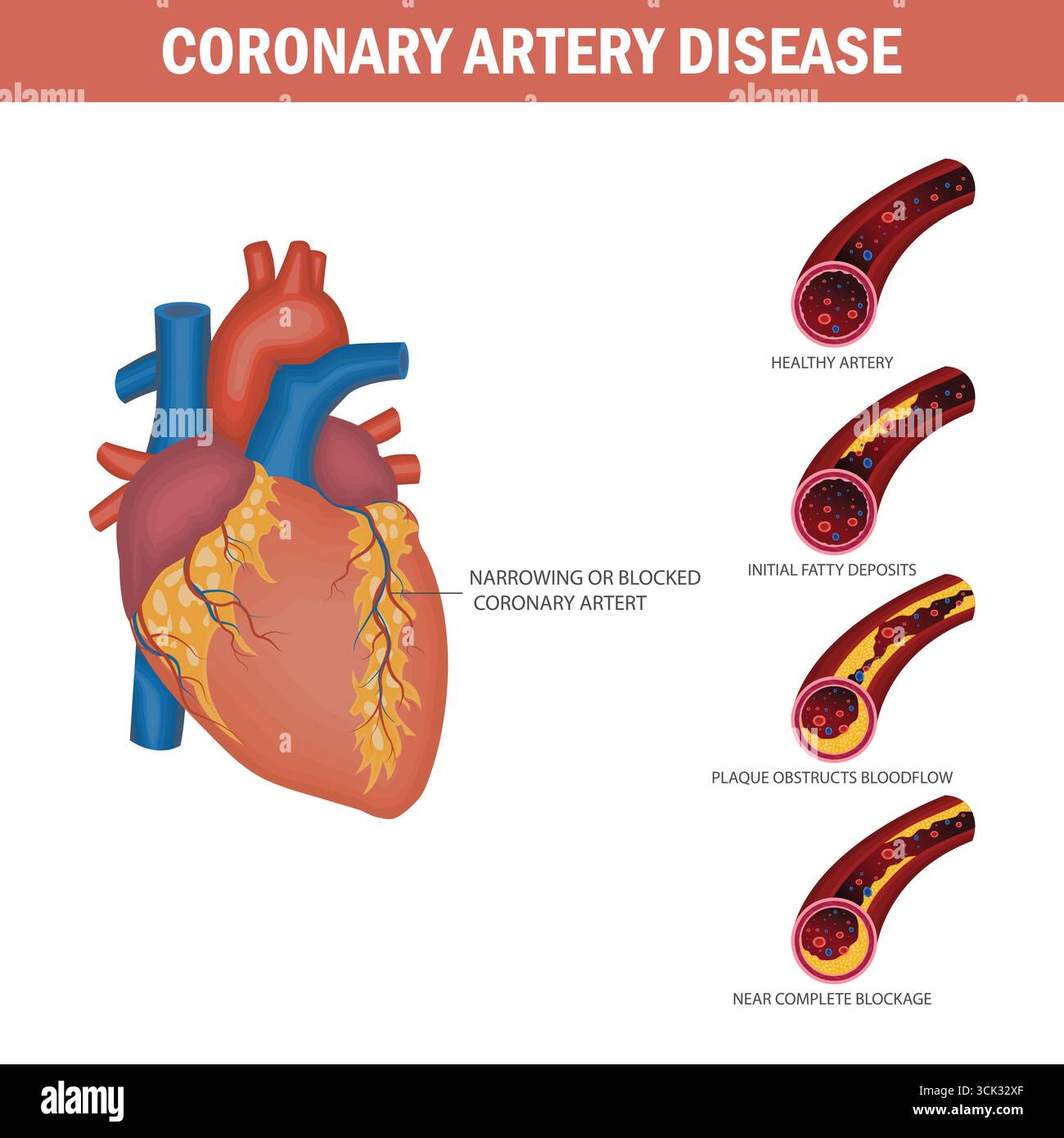 Medical illustration of coronary artery disease progression showing plaque buildup and heart artery blockage stages. Stock Vector