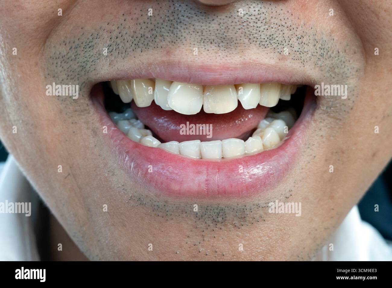 Open mouth crooked teeth hi-res stock photography and images - Alamy