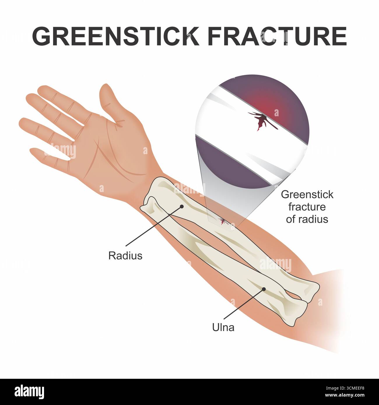 Compound Fracture Diagram
