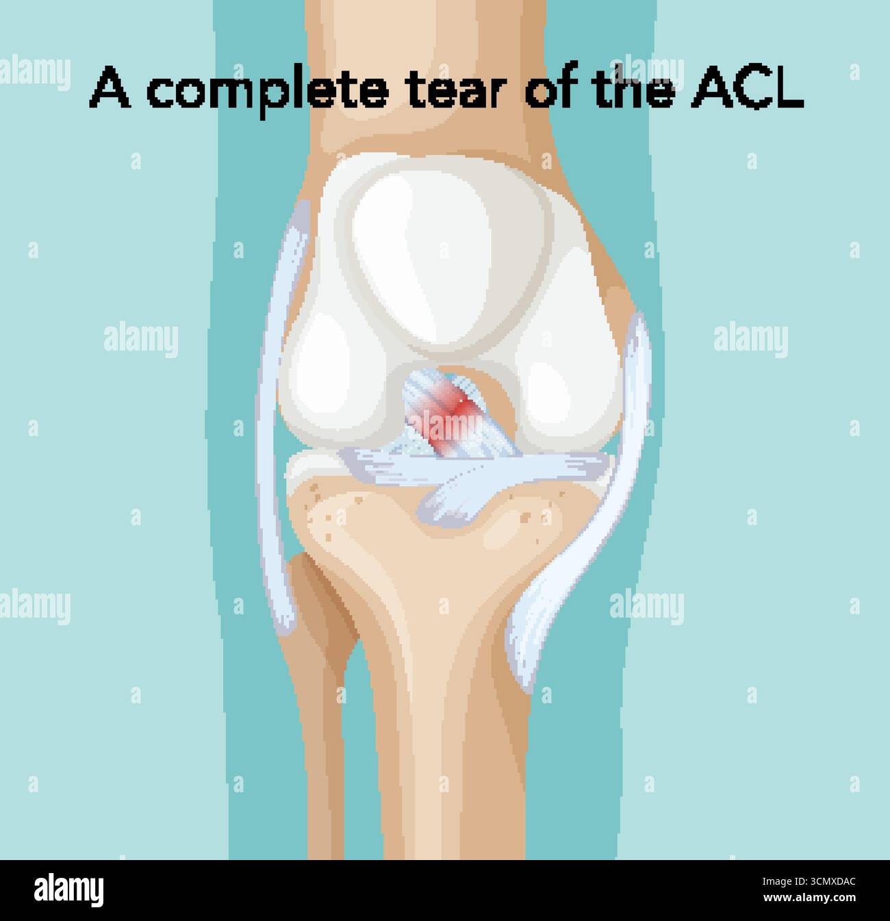 Vector illustration of a complete ACL knee tear with detailed, vibrant ...