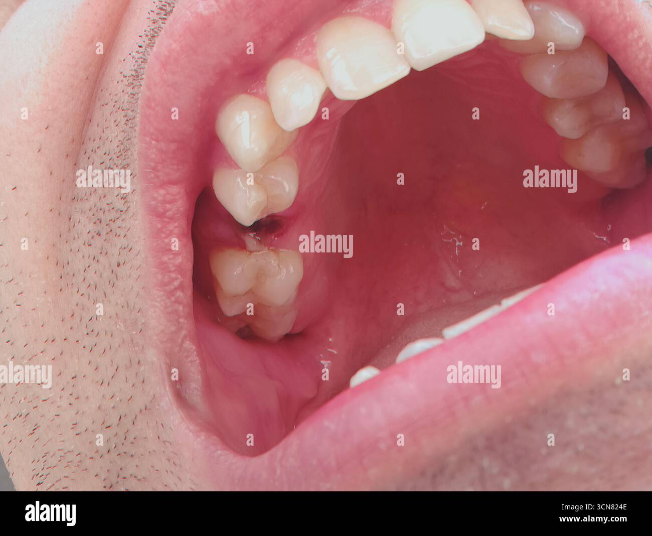 Open Mouth Of A Man With The Place Of A Pulled Out Small Molar Tooth Open Mouth Of A Man With The Place Of A Pulled Out Small Molar Tooth
