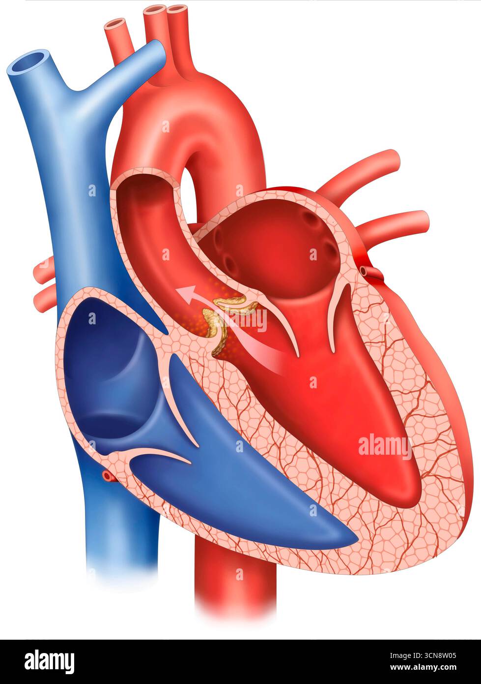 Illustration of aortic valve stenosis, a heart condition in which the ...
