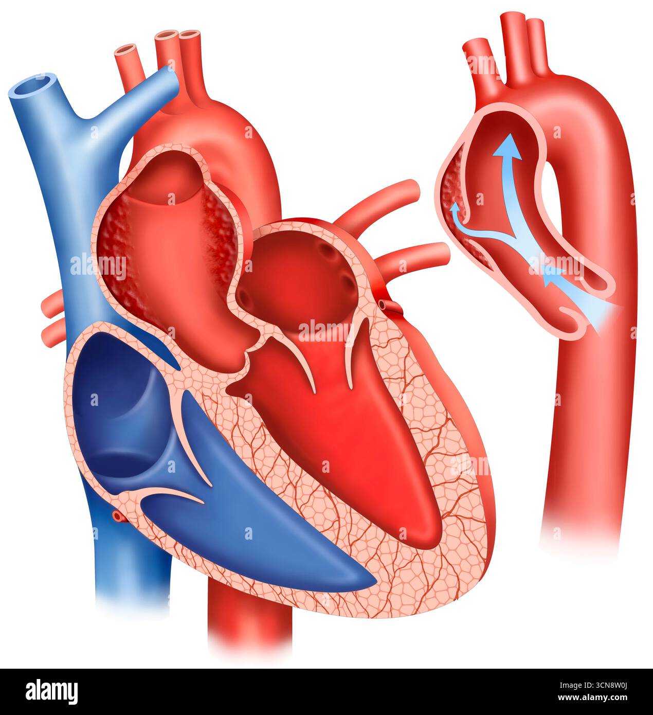 Internal Rupture Illustration of an aortic aneurysm, you can see the abnormal dilation ...
