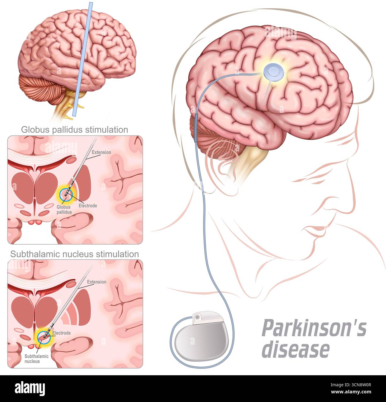 Deep brain stimulation for parkinsons Cut Out Stock Images & Pictures ...