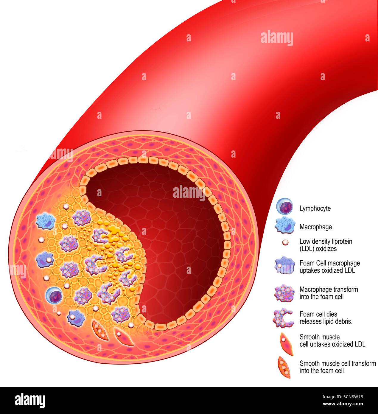 Atherosclerosis of the carotid arteries hi-res stock photography and ...