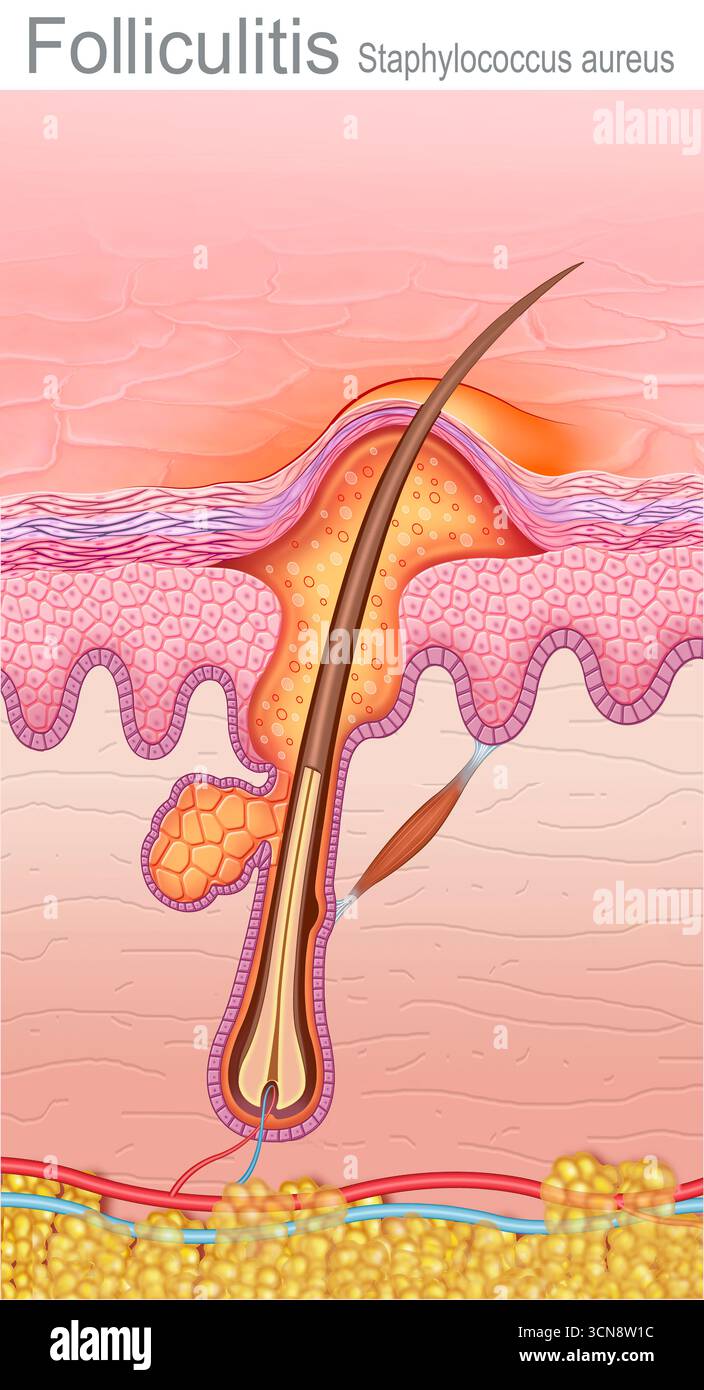 Illustration showing skin with a bacterial folliculitis infection. This ...