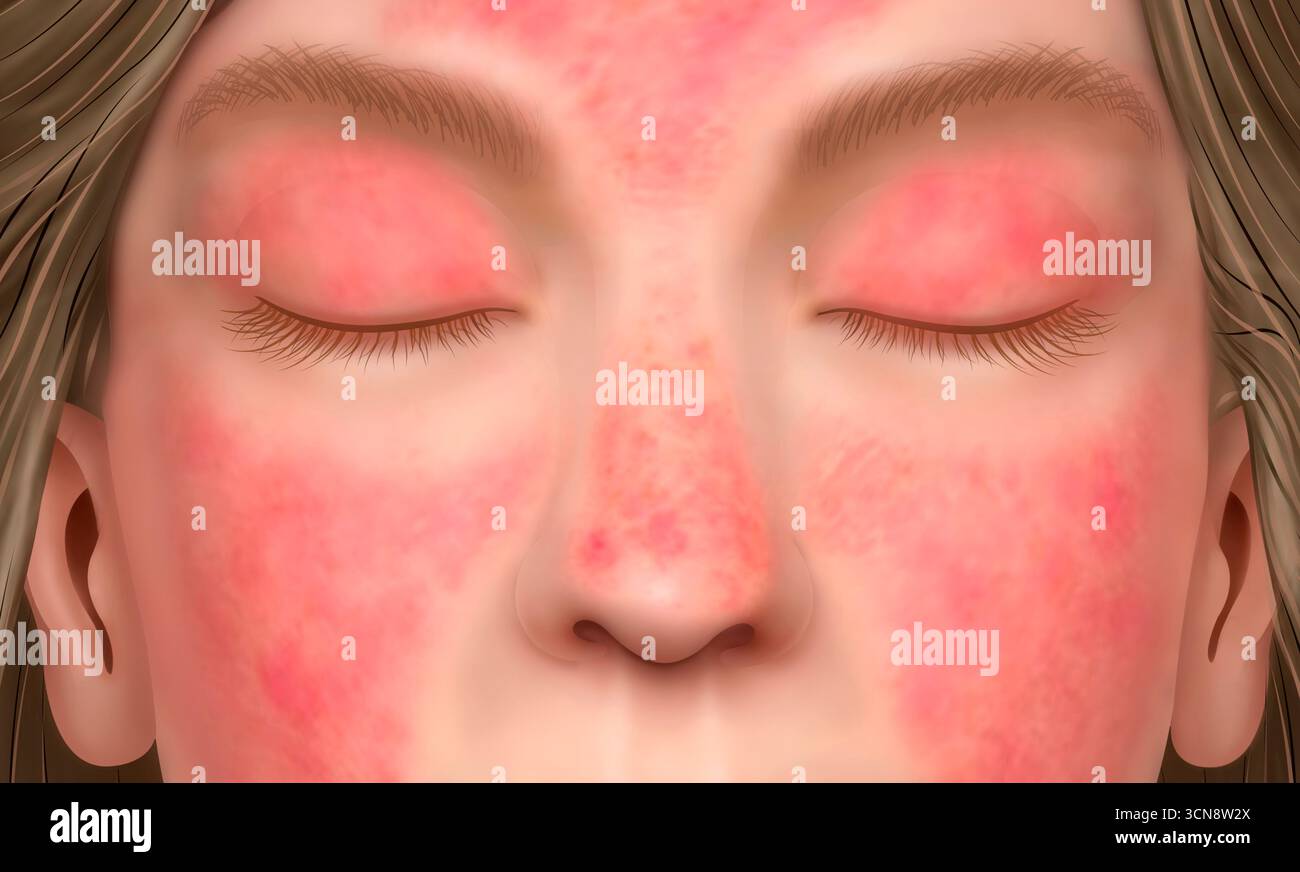Skin rash eyes hi-res stock photography and images - Alamy