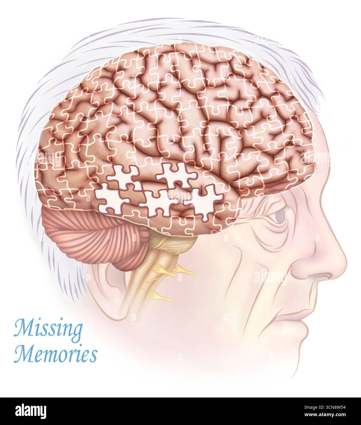 Conceptual illustration of memory loss in Alzheimer's disease depicting ...