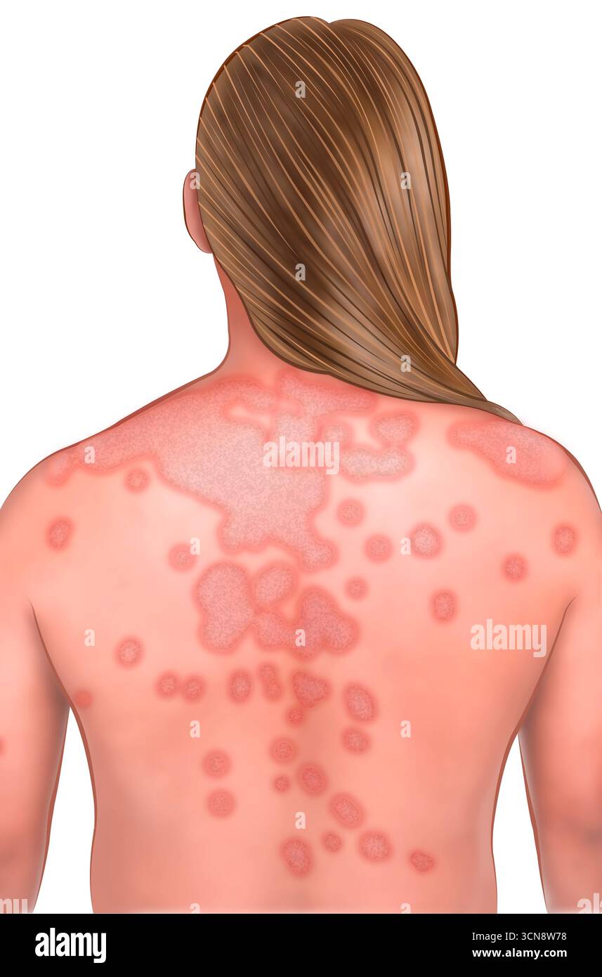 Illustration of the back of a woman affected by systemic lupus ...