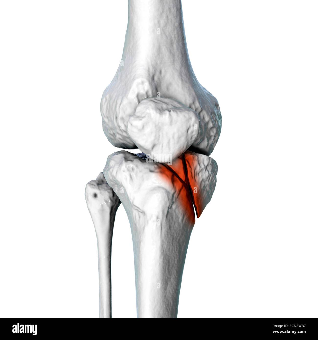 Tibia fracture Schatzker type IV. Illustration showing medial tibial ...