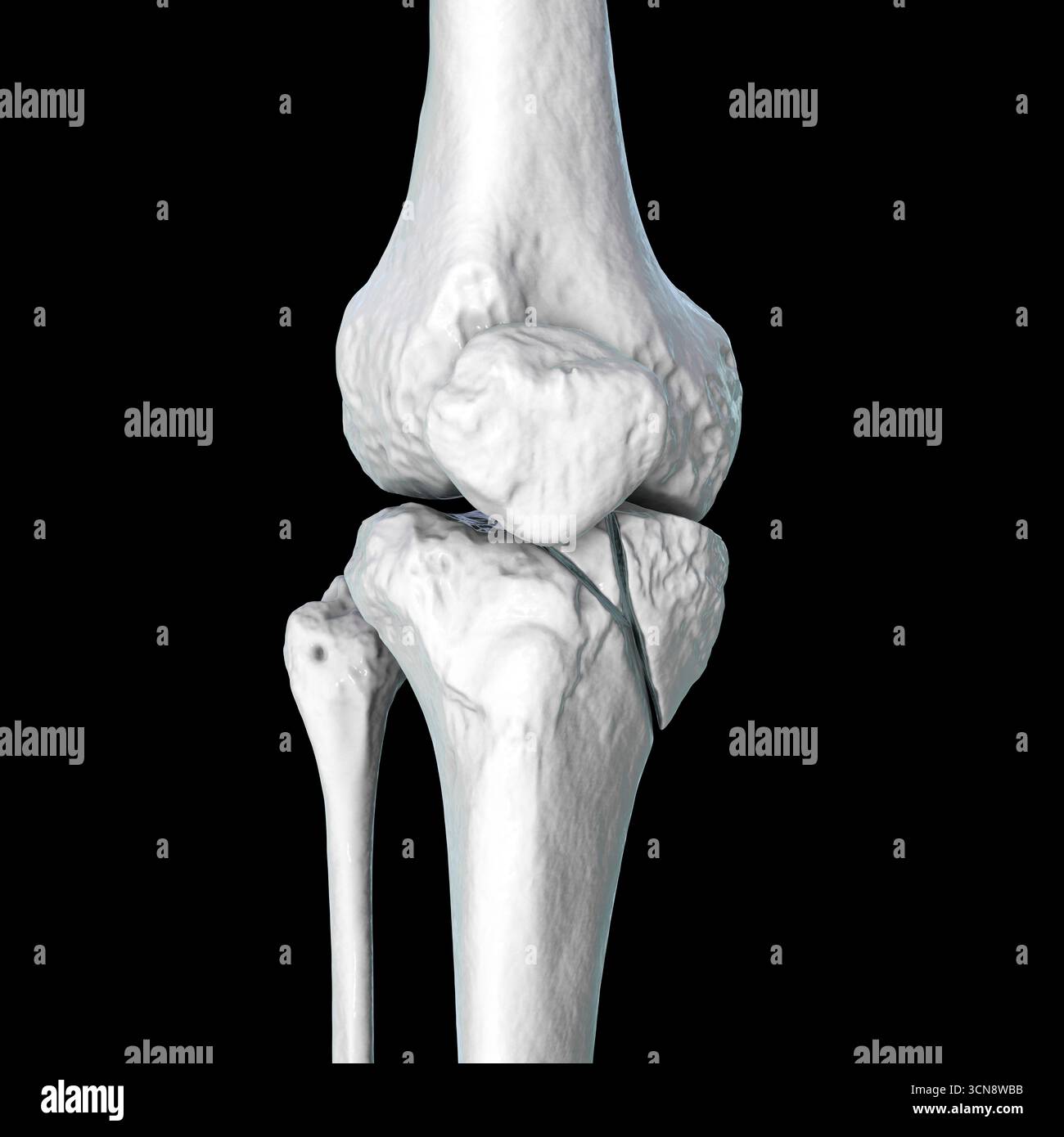 Medial Condyle Tibia Fracture