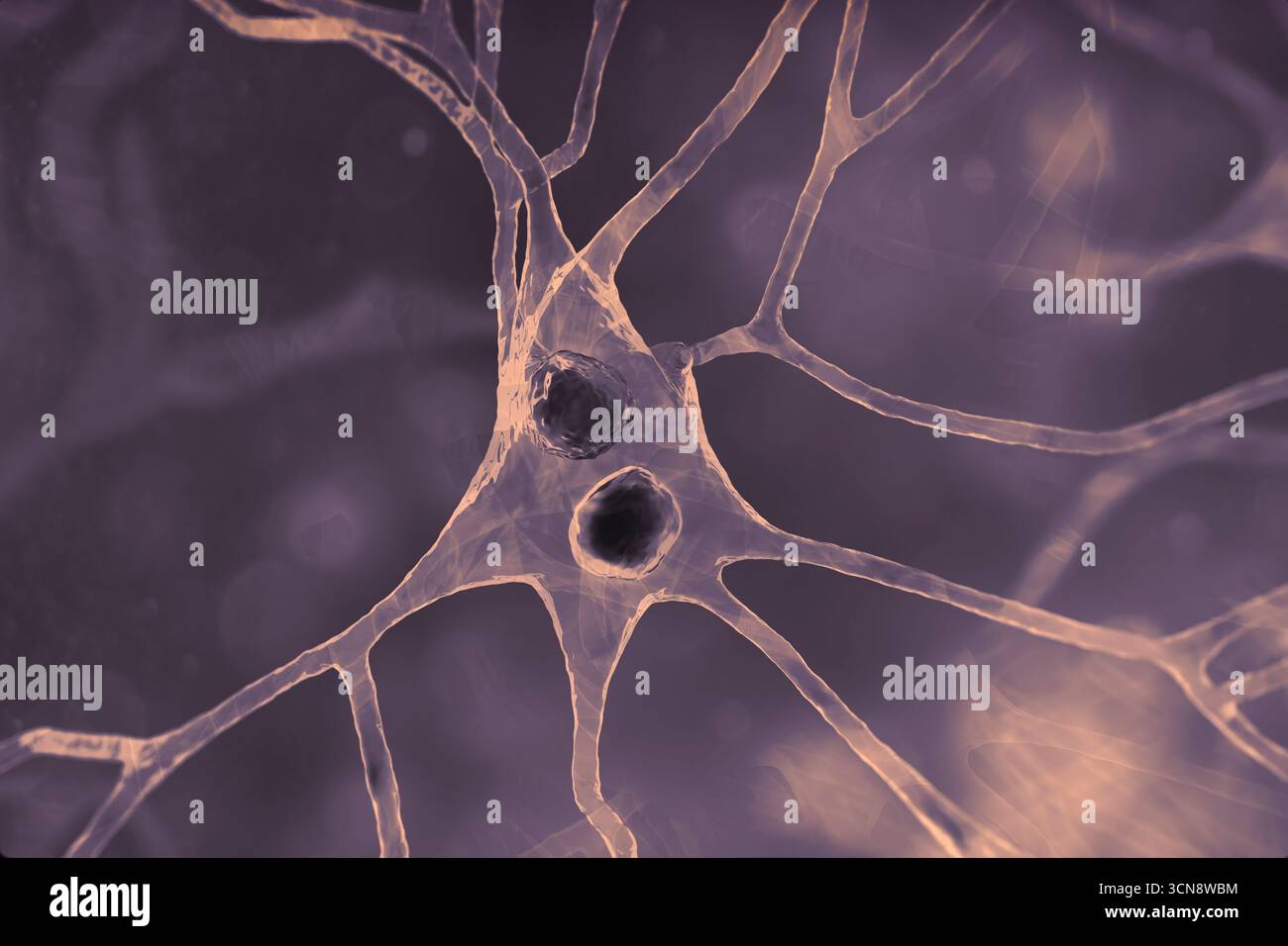 Lewy body dementia. Illustration showing neurons with Lewy bodies ...