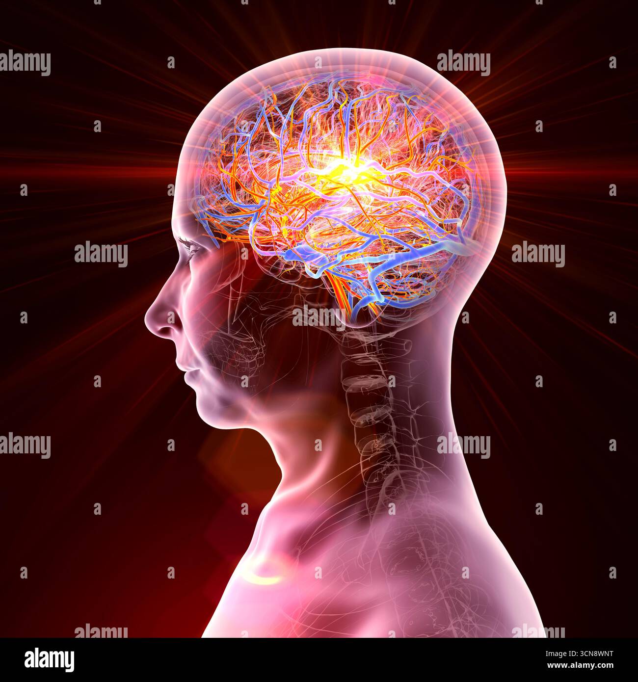 Conceptual illustration of a brain stroke, showing a human brain with ...