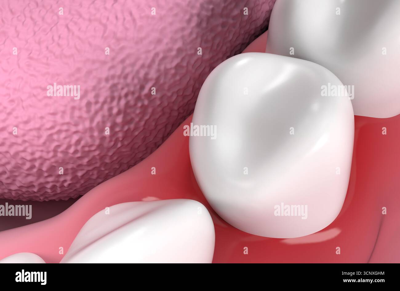 Inflammation of the gums (Gingivitis) - isometric view 3d illustration Stock Photo