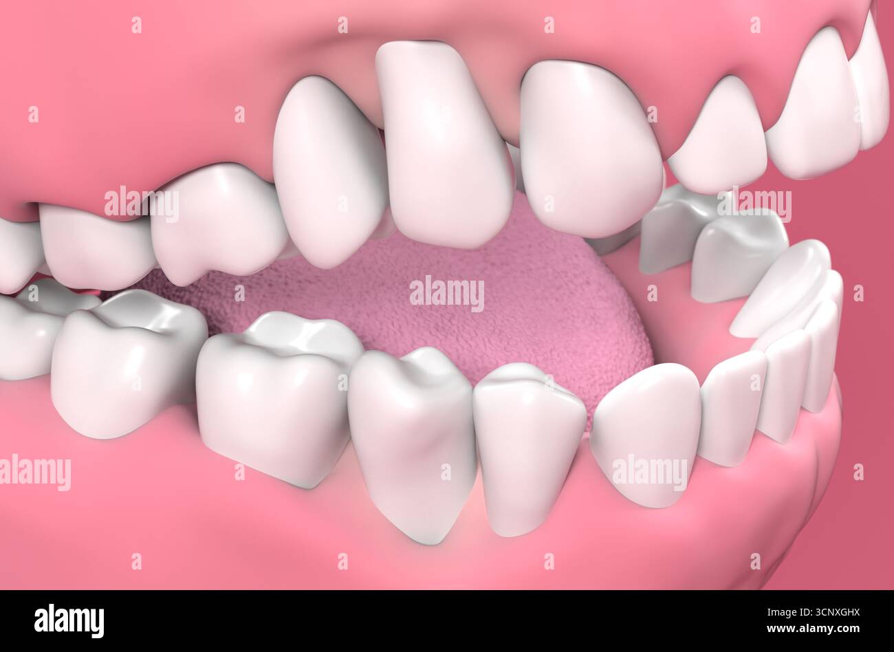 Gum recession - isometric view 3d illustration Stock Photo