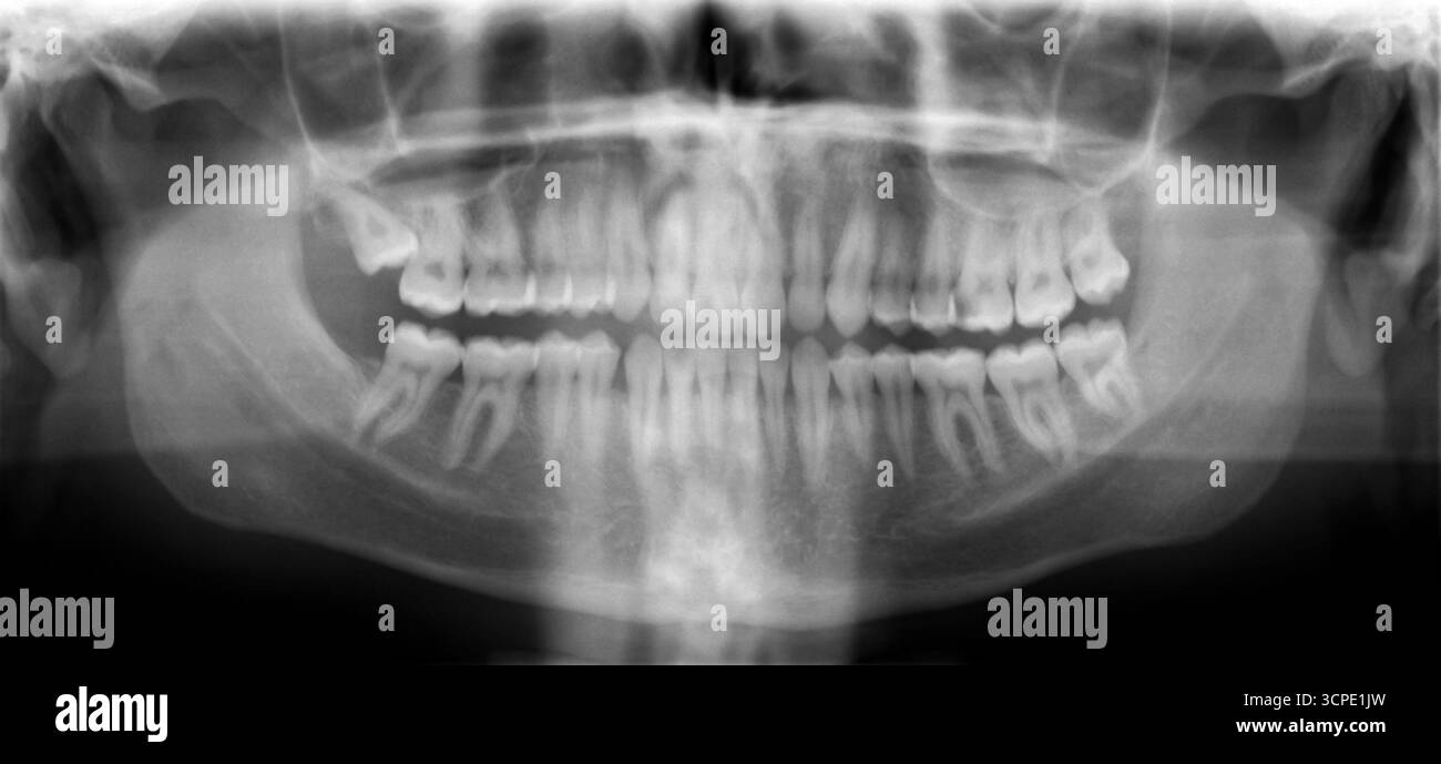 Panoramic dental X-ray radiograph image showing the entire mouth and ...