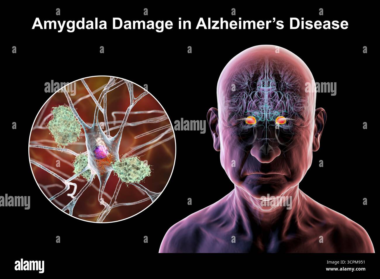 Illustration of a senior person with Alzheimer's disease, showing ...