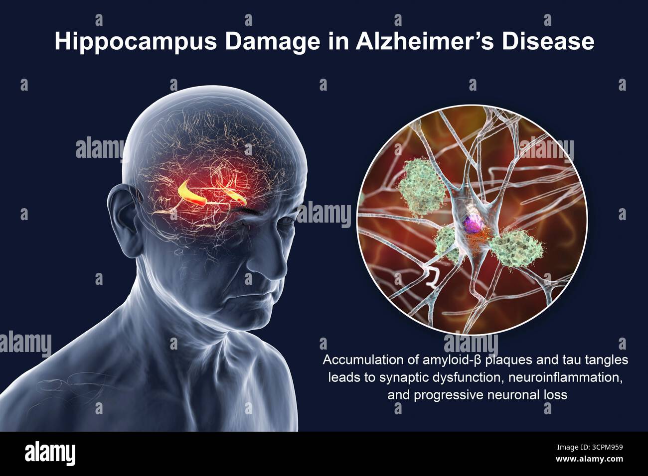 Alzheimer's disease plaques hi-res stock photography and images - Alamy