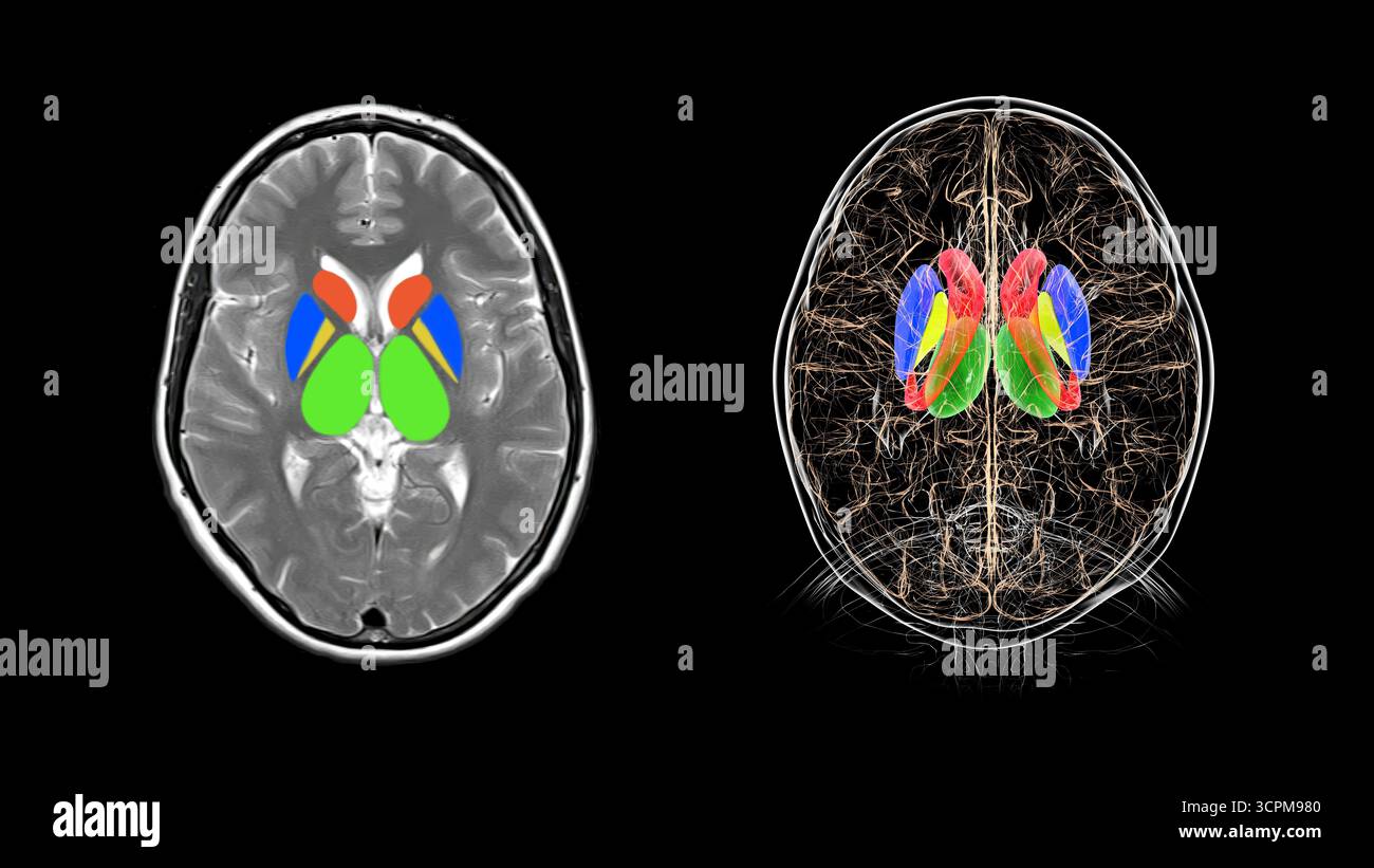 Human brain with caudate nucleus (red), thalamus (green), putamen (blue ...