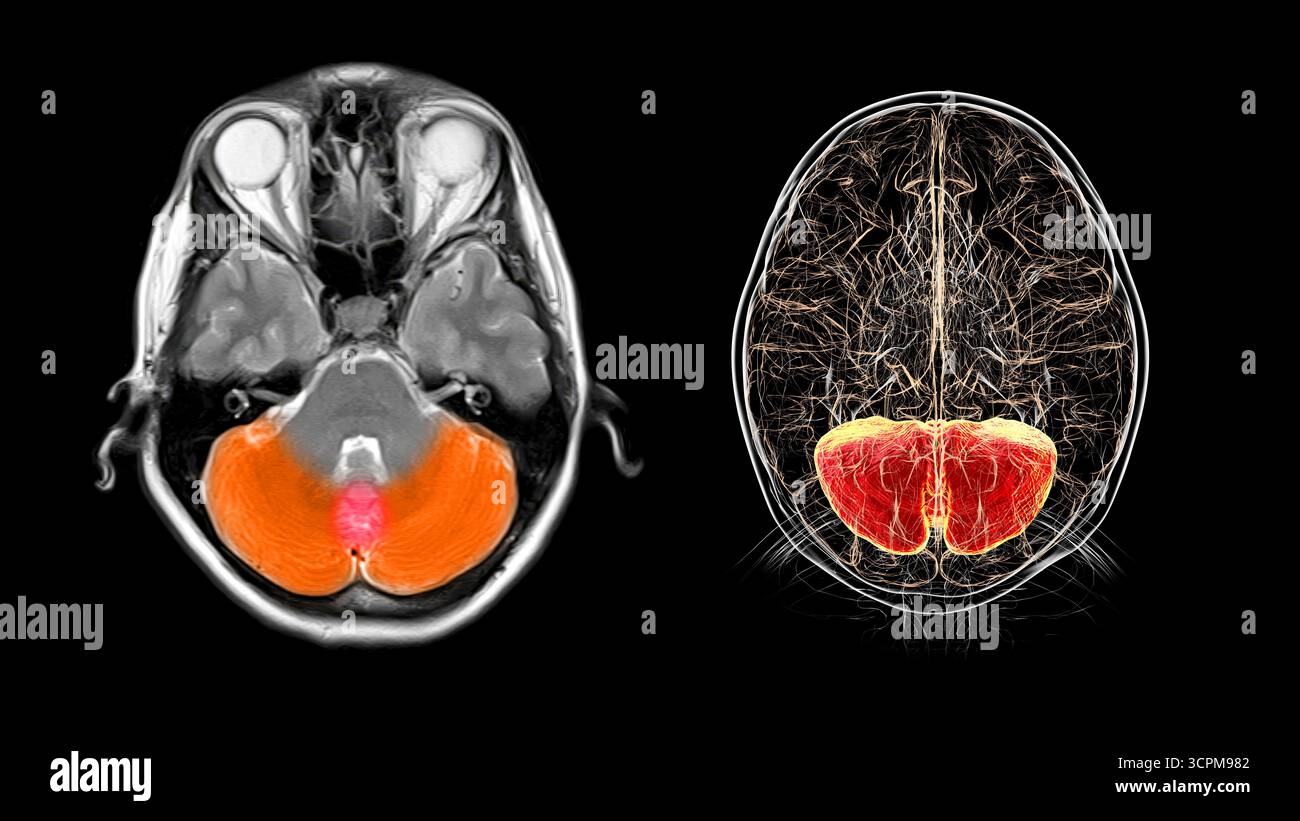 Magnetic resonance imaging (MRI) scan and illustration of the ...