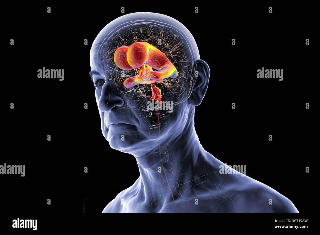 Compressed Brain Man Illustration of a senior person's brain with normal pressure ...