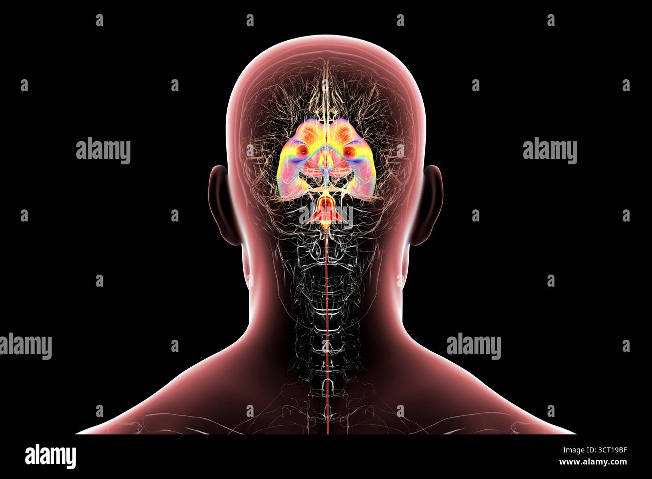 Compressed Brain Man Illustration of a human brain with normal pressure hydrocephalus. This ...