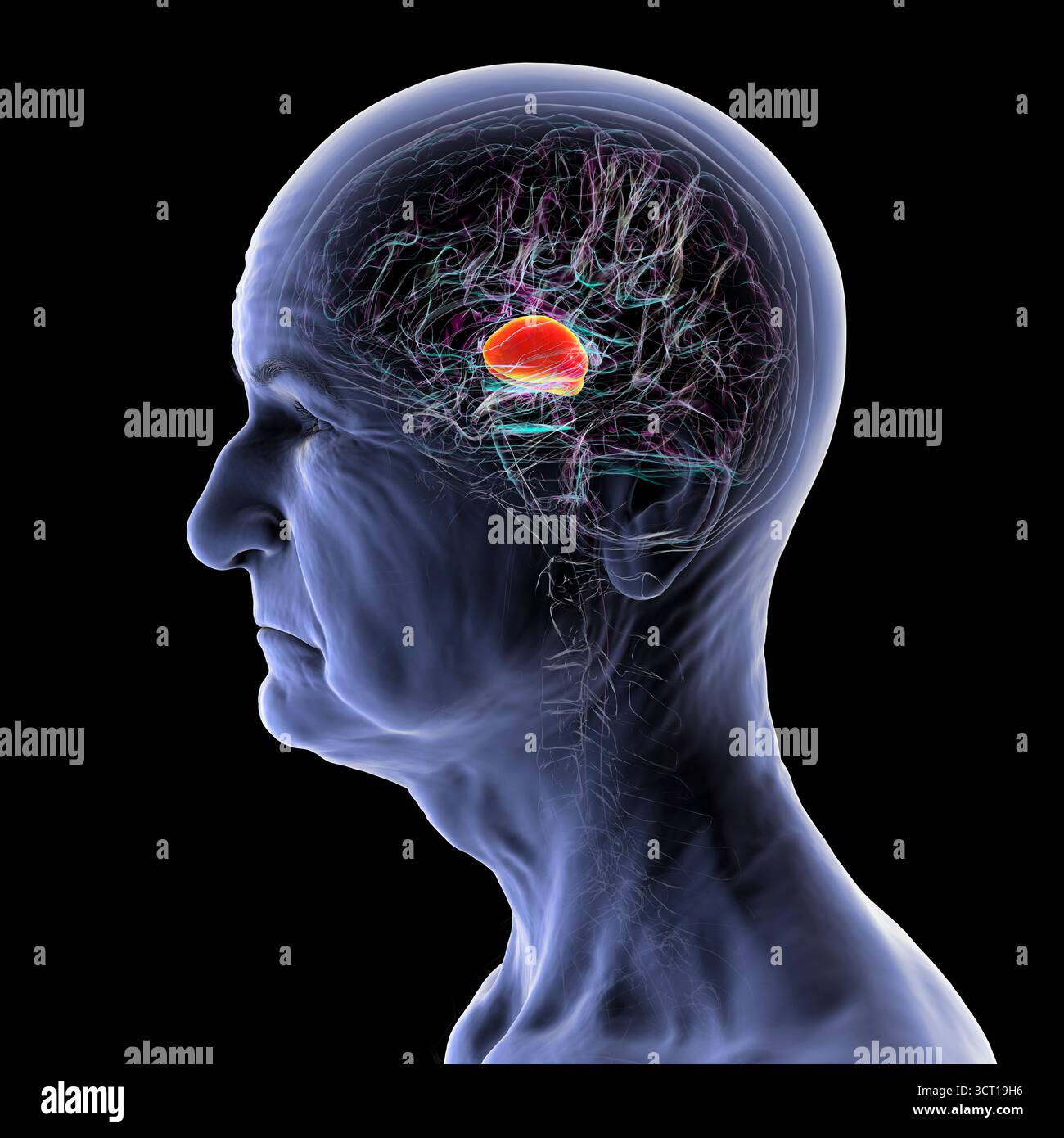 Frontal temporal dementia brain hi-res stock photography and images - Alamy