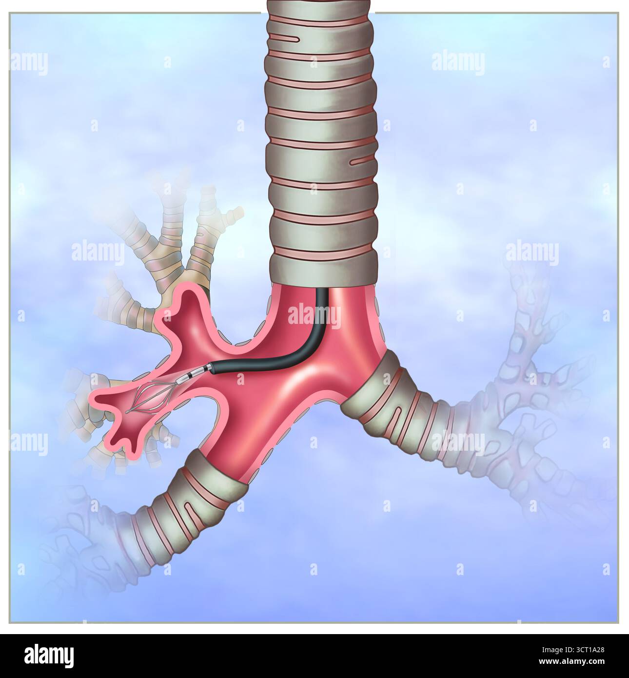 Bronchoscopy Visualization Lung visualization hi-res stock photography and images - Alamy