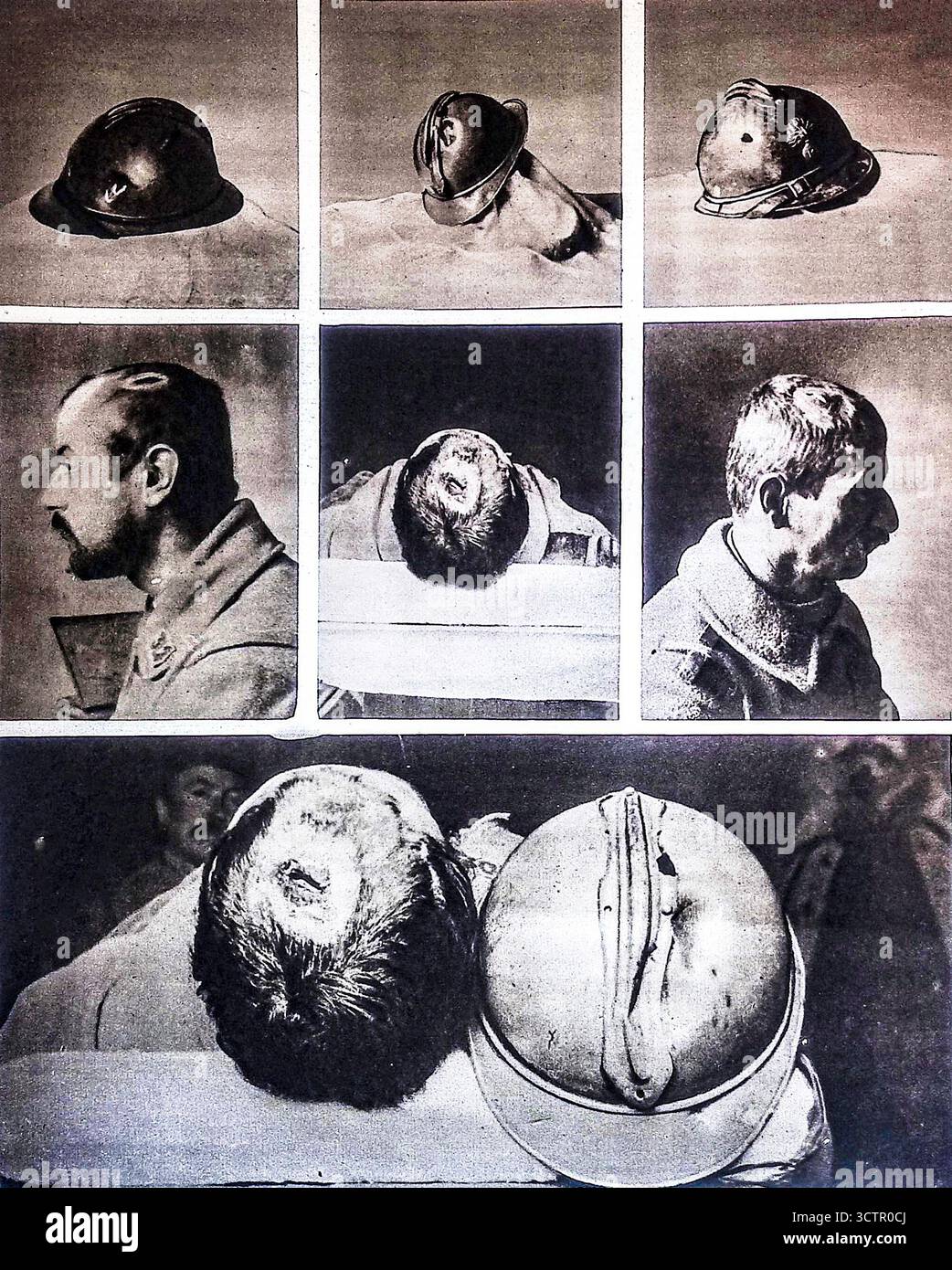 Shrapnel Injuries Bone Page from Le Miroir, 30 January 1916, showing French soldiers whose ...