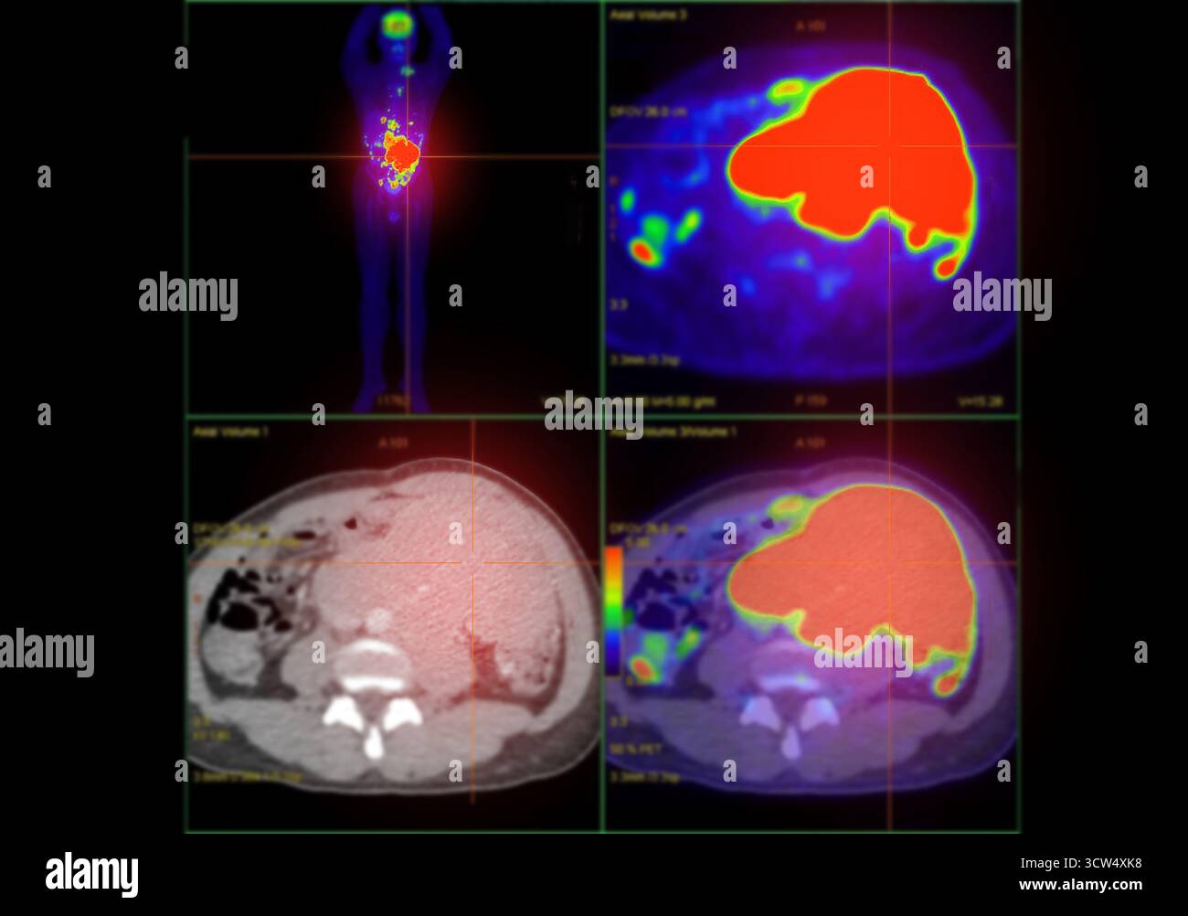 PET CT scan showing high metabolic activity in abdominal region ...