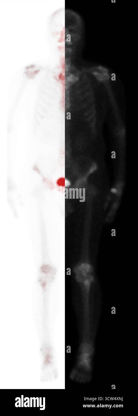 Whole body bone scan was performed following intravenous injection of ...