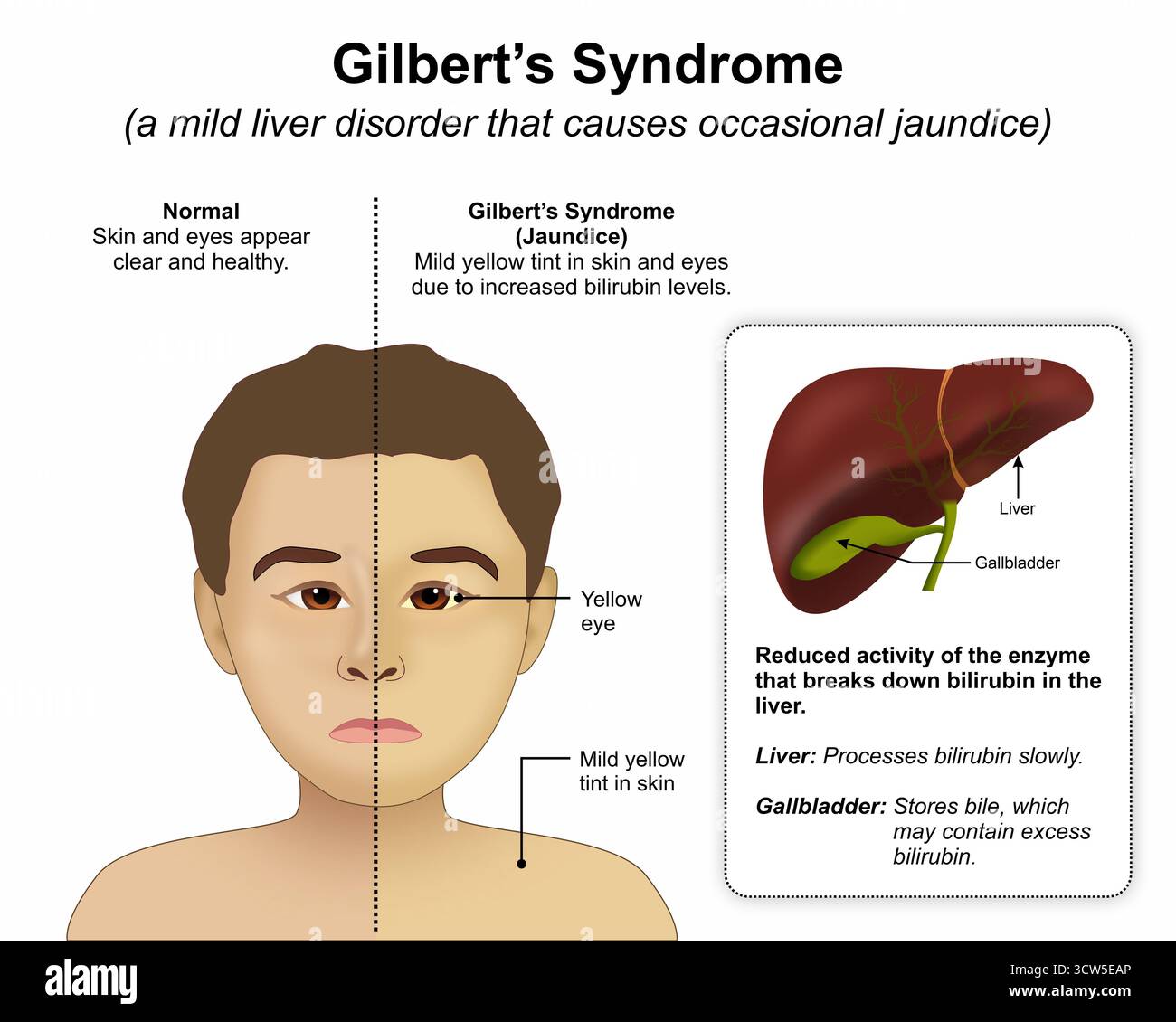 Gilberts Syndrome Hi res Stock Photography And Images Alamy gilberts-syndrome-hi-res-stock-photography-and-images-alamy