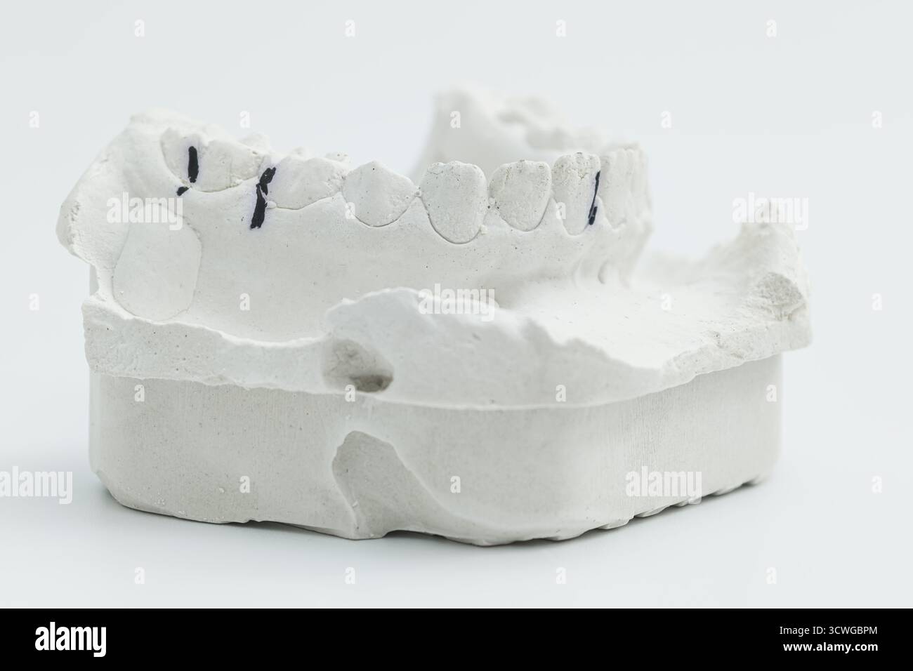 Dental cast hi-res stock photography and images - Alamy