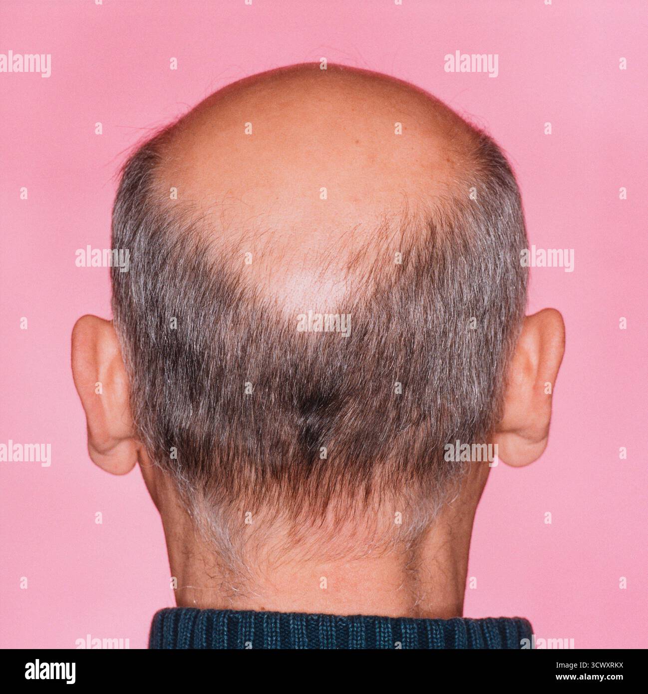 Nahaufnahme eines Hinterkopfs eines Mannes mit einer deutlichen Glatze oder Haarausfall *** Close-up of the back of a mans head with significant baldn Stock Photo